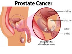 Men's Health Matters: 1 In 8 At Risk For Prostate Cancer; Is Early Detection The Key?