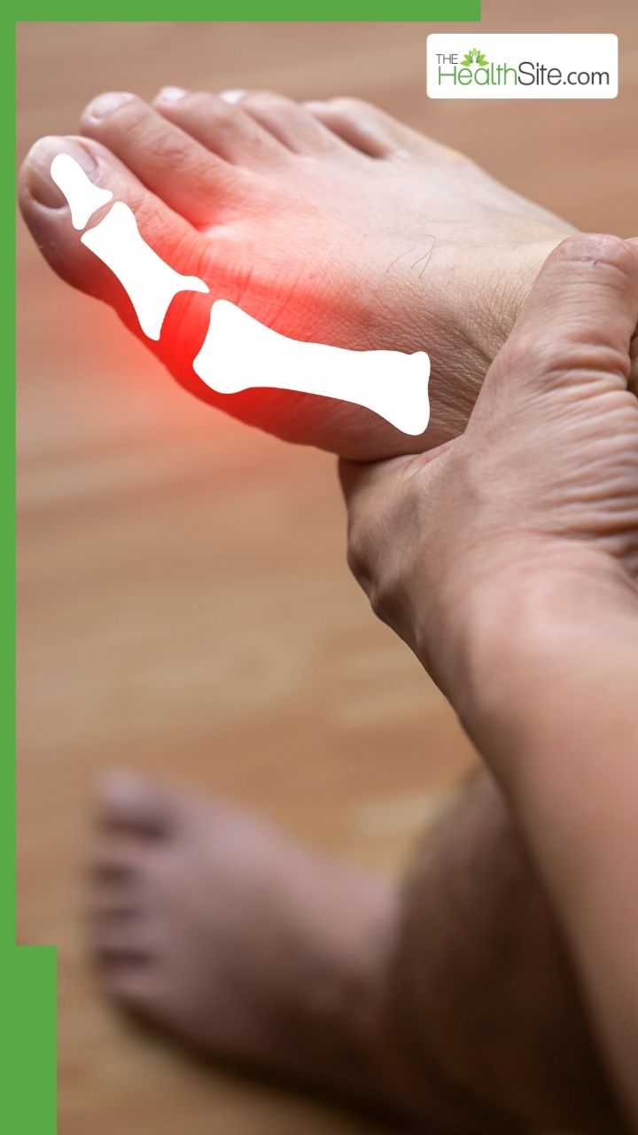 यूरिक एसिड बढ़ने पर शरीर में दिखाई देते हैं ये 8 लक्षण