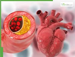 Clogged Arteries Side Effects: LDL Cholesterol Can Lead To These 5 Dangerous Diseases