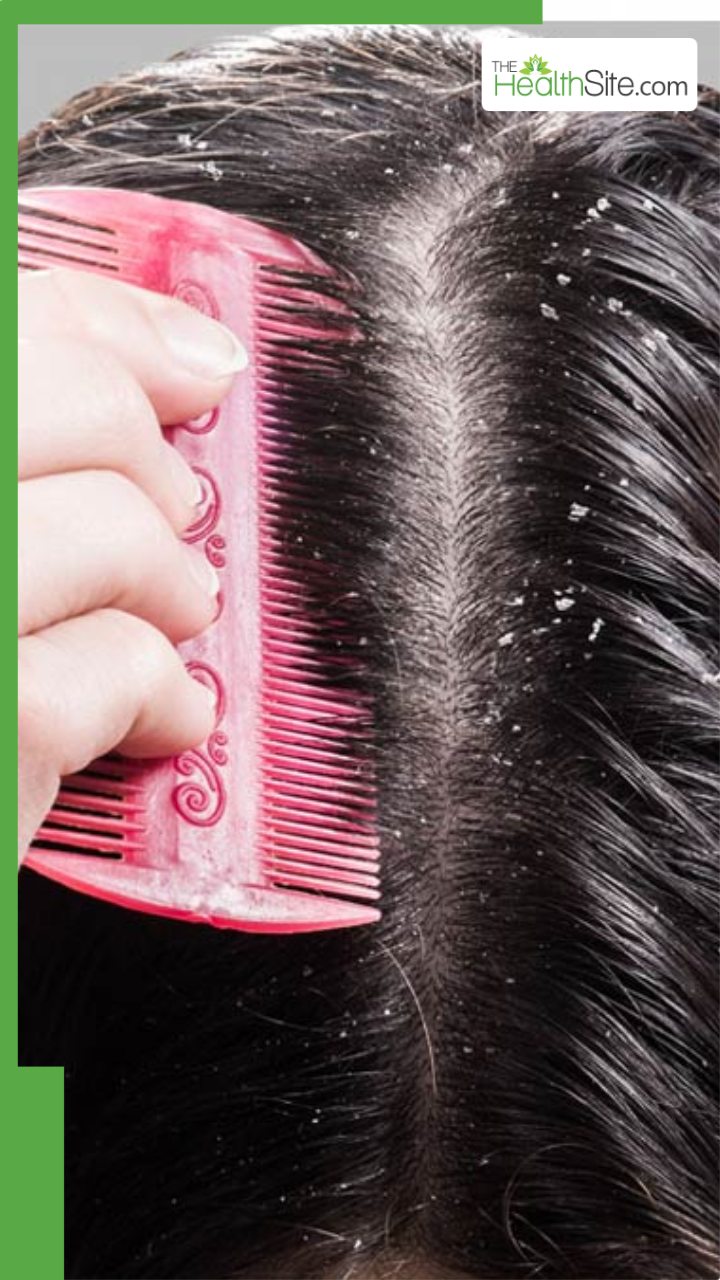 डैंड्रफ को जड़ से खत्म करने के लिए क्या करें?
