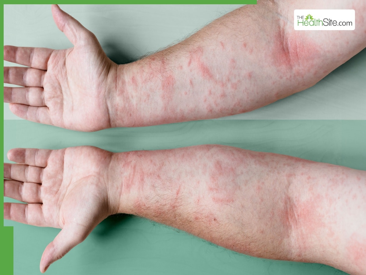 Winter Itch: What Causes It And How To Prevent It | TheHealthSite.com