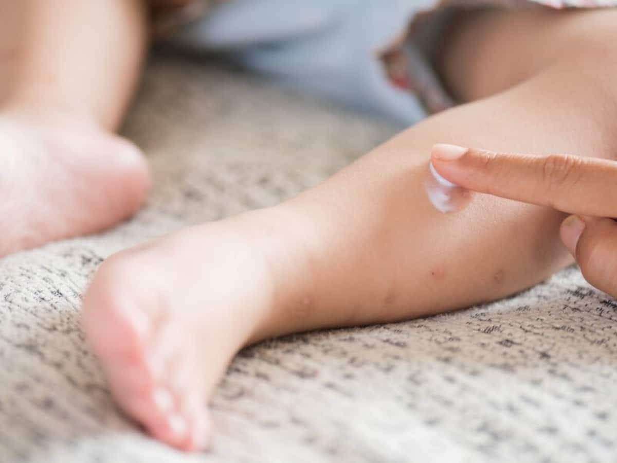 Atopic dermatitis, Early Signs of Atopic Dermatitis, Symptoms of Atopic Dermatitis, Newborn care, skincare tips for kids, parenting tips, Atopic Dermatitis in babies, Atopic Dermatitis in newborn babies