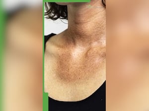 काली गर्दन को साफ करने के 8 घरेलू नुस्खे