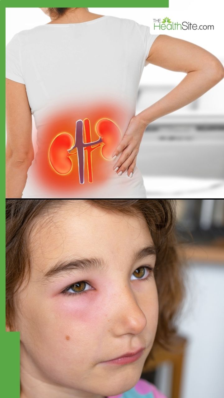 किडनी डैमेज होने पर चेहरे पर दिखते हैं ये 5 लक्षण