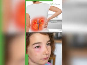 किडनी डैमेज होने पर चेहरे पर दिखते हैं ये 5 लक्षण