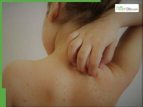 कनाडा में तेजी से फैल रही है Measles की बीमारी, 5 नये केसेस की हुई पुष्टि