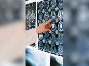 Introduce These 6 Lifestyle Changes To Prevent Brain Stroke; WHO