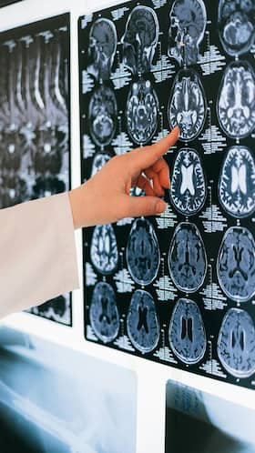 Introduce These 6 Lifestyle Changes To Prevent Brain Stroke; WHO