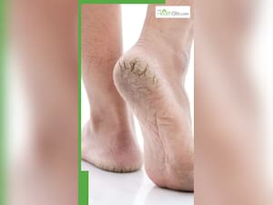 फटी एड़ियों को मुलायम बनाने के 9 आसान उपाय
