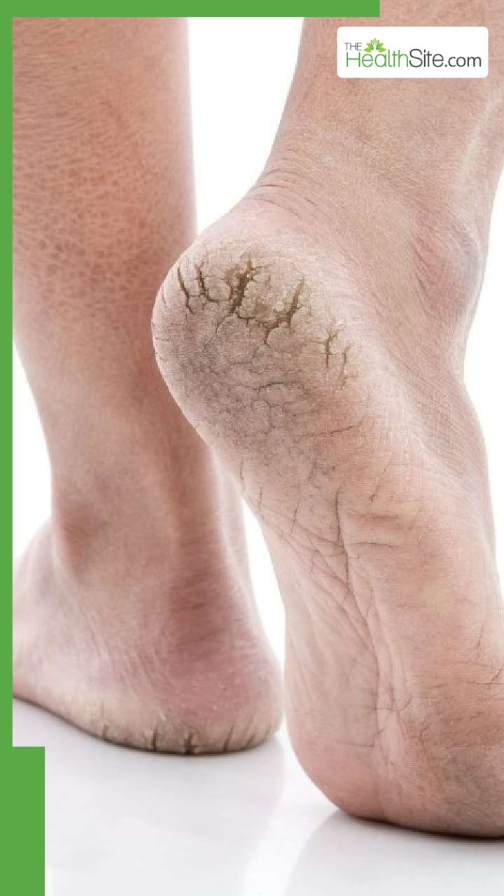 फटी एड़ियों को मुलायम बनाने के 9 आसान उपाय