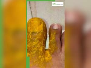 क्यों लगाया जाता है चोट पर हल्दी का लेप?