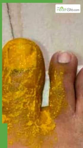 क्यों लगाया जाता है चोट पर हल्दी का लेप?