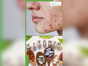 इन विटामिन्स की कमी के कारण होती है स्किन खराब