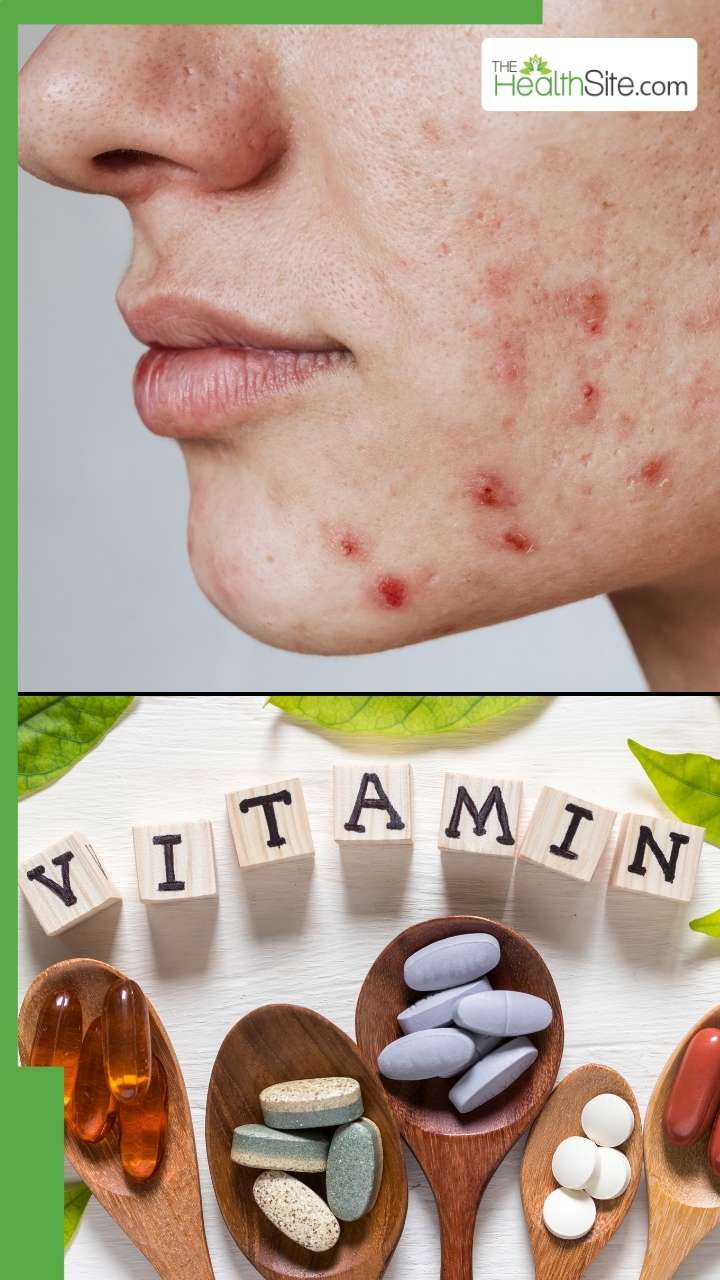 इन विटामिन्स की कमी के कारण होती है स्किन खराब