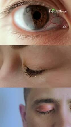 Dry Eye Syndrome Symptoms