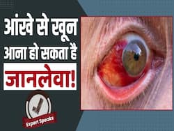 Marburg Virus: आंखों से खून आना हो सकता है इस बीमारी का लक्षण