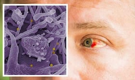 नॉर्मल नहीं है Bleeding Eye Virus, संक्रमण जल्दी लेता है अपनी गिरफ्त में