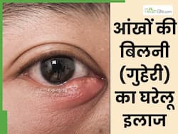 आंखों की बिलनी (गुहेरी) को ठीक करने के लिए आजमाएं ये 5 घरेलू उपाय, दर्द और सूजन से तुरंत मिलेगी राहत