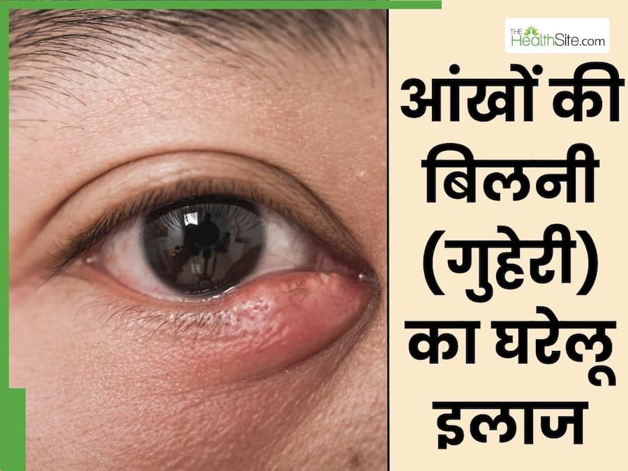 Aankho Me Bilni Ka Ilaj | आंखों की बिलनी (गुहेरी) को ठीक करने के लिए ...
