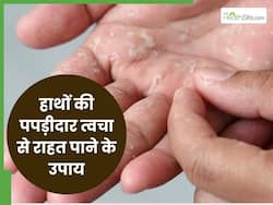 सर्दियों में हाथों से निकलने लगती है पपड़ीदार स्किन? इन 5 आसान से नुस्खें से करें इलाज