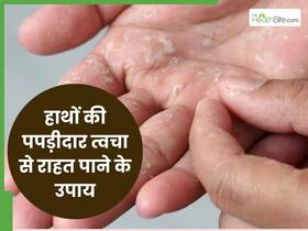 सर्दियों में हाथों से निकलने लगती है पपड़ीदार स्किन? इन 5 आसान से नुस्खें से करें इलाज