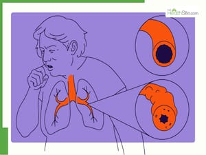 Understanding COPD: Early Detection And Prevention