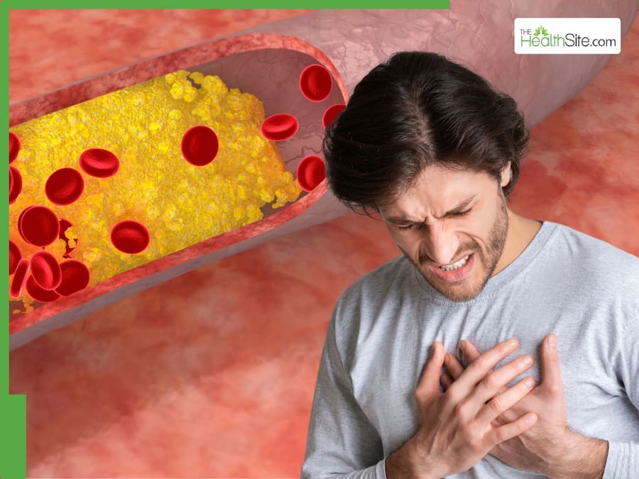 High Cholesterol Side Effects 5 Warning Signs of Clogged Arteries You