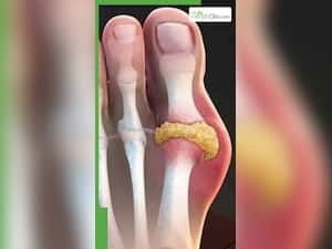 पेशाब में दिखते हैं यूरिक एसिड के ये 5 लक्षण