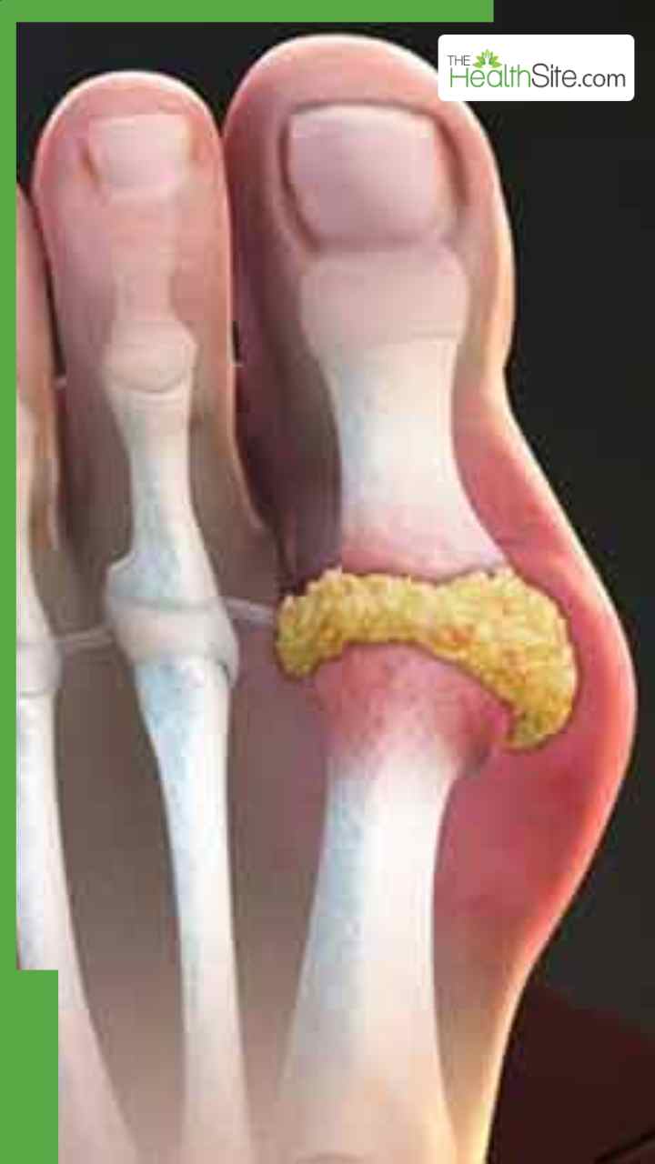 पेशाब में दिखते हैं यूरिक एसिड के ये 5 लक्षण