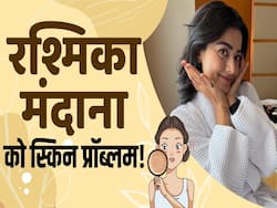 एक्ट्रेस रश्मिका मंदाना को है स्किन से जुड़ी ये समस्या, देखें ये वीडियो