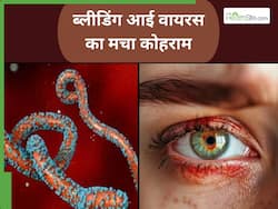 Bleeding Eye Virus ने ली 15 लोगों की जान, जानिए क्या है ये बीमारी और इसके लक्षण