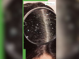 ड्रैंडफ को हमेशा के लिए खत्म कर देंगे ये देसी उपाय