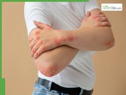 इस रेयर स्किन डिजिज से परेशान हैं एक्ट्रेस रश्मिका मंदाना, पूरी स्किन हो जाती है टमाटर जैसी लाल