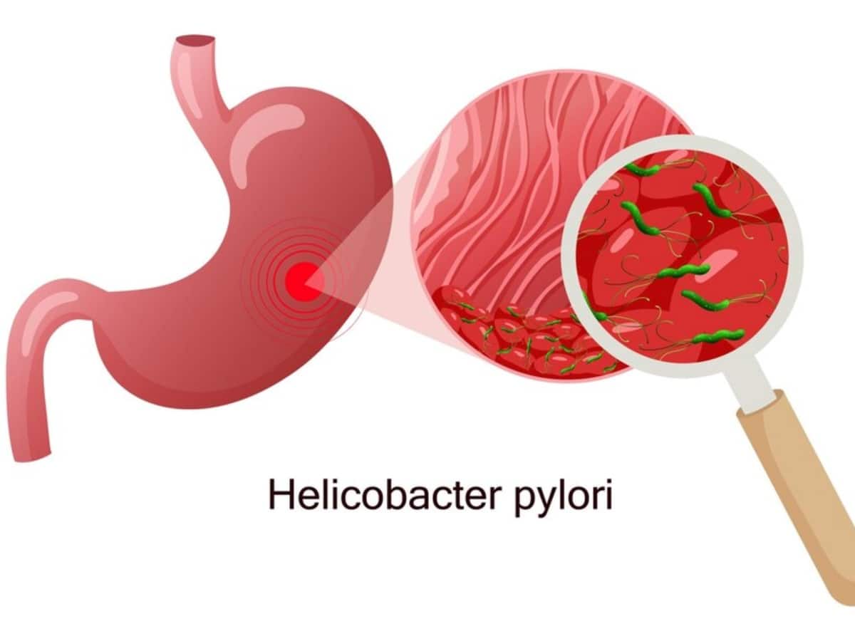 Stomach Cancer, Gastric Stomach Cancer, Stomach cancer risk, Stomach Cancer Causes, Stomach Cancer signs, Stomach Cancer screening, Stomach Cancer diagnosis, Stomach Cancer treatment, Stomach Cancer prevention, Stomach Cancer risk factors, Stomach Cancer in men, Stomach Cancer in women, Stomach Cancer risk in men