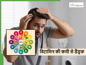 सिर में बार-बार हो रहा डैंड्रफ तो सिर्फ सर्दी ही नहीं बल्कि शरीर में इस विटामिन की कमी भी हो सकती है कारण
