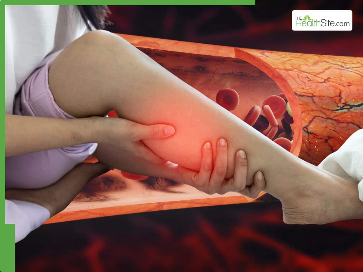 High Cholesterol Symptoms In Legs At Night: 5 Warning Signs of ...