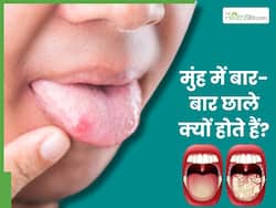 इन 5 बीमारियों के कारण मुंह में बार-बार होने लगते हैं छाले, हर 10 में से 9 व्यक्ति करता है इग्नोर