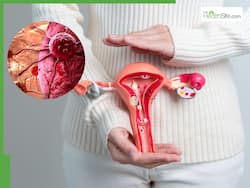 Can Probiotics Help Prevent Cervical Cancer? Exploring the Link Between Vaginal Microbiome and Health