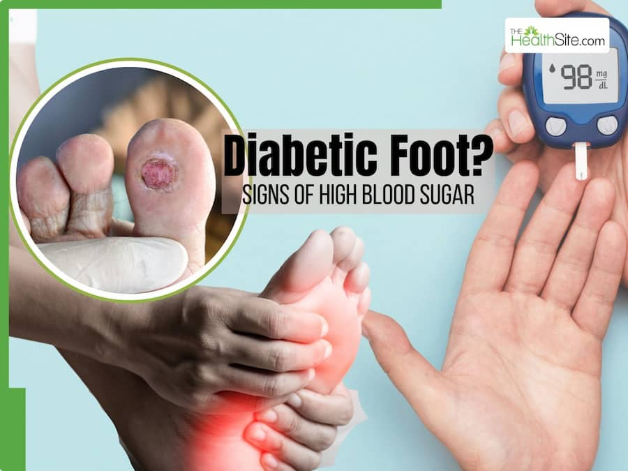 Diabetic Foot and 7 Other Warning Signs of High Blood Sugar Levels in the Body