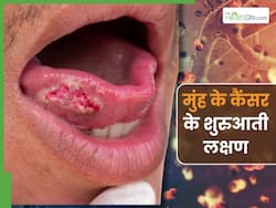 मुंह में कैंसर की ओर इशारा करते हैं शरीर में आए ये 5 बदलाव, दांतों में नजर आता है सबसे पहला लक्षण