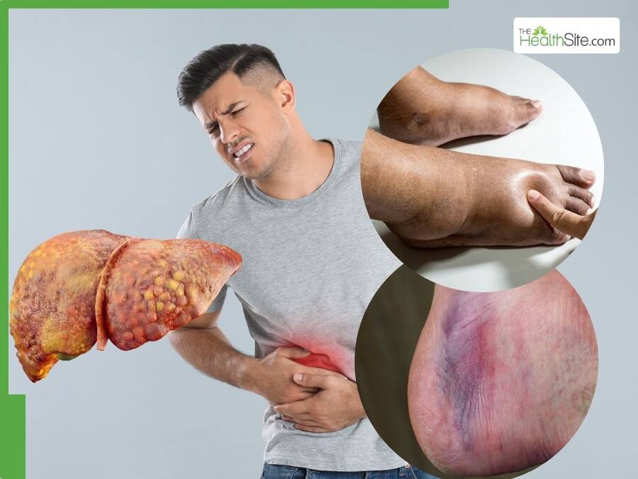 इन 5 संकेतों से समझ जाएं लिवर के पास जमा होने लगी है चर्बी, भूलकर भी न करें नजरअंदाज