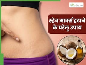 वजन कम करने के बाद बॉडी पर दिखने लगे हैं स्ट्रेच मार्क्स, तो ये 5 घरेलू उपाय दिलाएंगे इनसे जल्द छुटकारा
