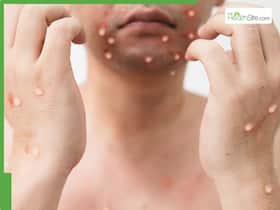 Karnataka Confirms First Mpox Case in 2025: Dubai Returnee Tests Positive For Mpox In Mangaluru Karnataka Confirms First Mpox Case in 2025: Dubai Returnee Tests Positive For Mpox In Mangaluru