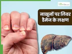 लिवर डैमेज का संकेत हैं नाखूनों में दिखने वाले ये 5 लक्षण, 90 फीसदी लोग साधारण समझकर करते हैं इग्नोर