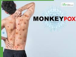 First Case Of New Mpox Variant, Clade Ib, Reported In France