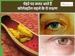 बैड कोलेस्ट्रॉल बढ़ने पर चेहरे पर दिखाई देने लगते हैं ये 5 लक्षण, इस हिस्से में होने लगती है सूजन