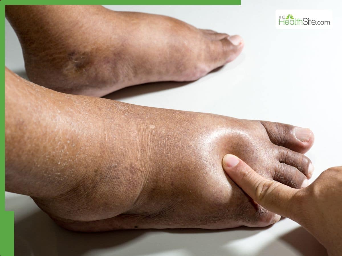 Swollen Feet Causes 20 Diseases That Can Lead To Severe Feet ...