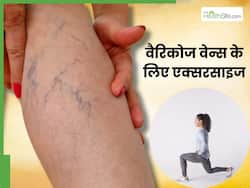 वैरिकोज वेन्स (उभरी नीली नसों) से हैं परेशान तो रोज करें ये 4 एक्सरसाइज, मिलेगी जल्द राहत