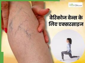 वैरिकोज वेन्स (उभरी नीली नसों) से हैं परेशान तो रोज करें ये 4 एक्सरसाइज, मिलेगी जल्द राहत