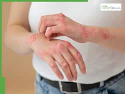 Dealing With Atopic Dermatitis In Winter: Cause, Symptoms, Treatment, Prevention